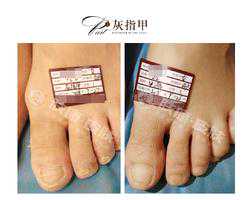 得了灰指甲怎么治疗？4种方法助指甲恢复