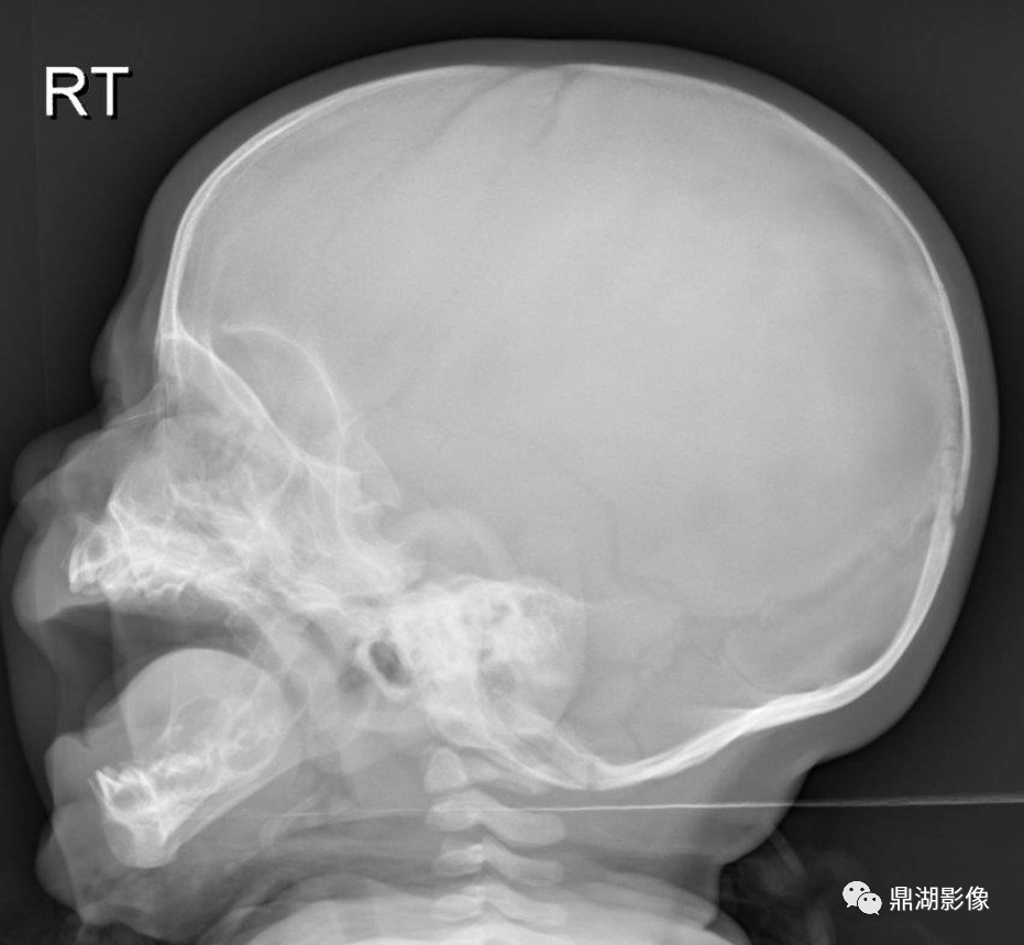 收藏 | 头颅平片阅片顺序