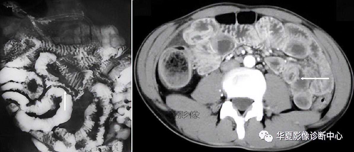 39种腹部典型征象，值得收藏