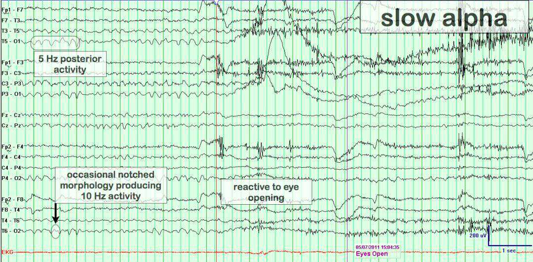 正常变异篇：最一目了然的成人脑电图图谱丨一键收藏